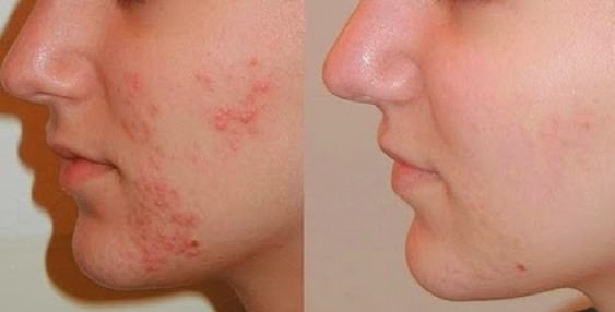 5 cách trị mụn tự nhiên không phải ai cũng biết