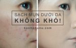 Vì sao mụn dưới da trị không hết?