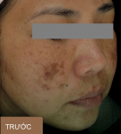 Sau 27 ngày kiên trì, tôi đã trị sạch nám