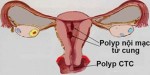 POLYP TỬ CUNG - bệnh đe dọa khả năng có con của chị em