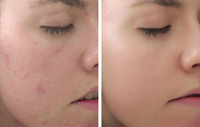 Làm thế nào để loại bỏ mụn nội tiết?