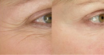 Nếp nhăn vùng quanh mắt: Nên xóa bằng cách nào hiệu quả?