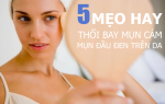 5 mẹo giúp loại bỏ mụn cám, mụn đầu đen nhanh chóng tại nhà