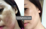 Thần kỳ trị tận gốc nám sâu chỉ trong 6 tuần!
