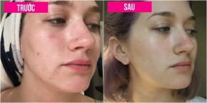 Thí nghiệm không nặn mụn 7 ngày và kết quả gây sốc