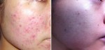Dị ứng mỹ phẩm - cách xử trí và phòng ngừa