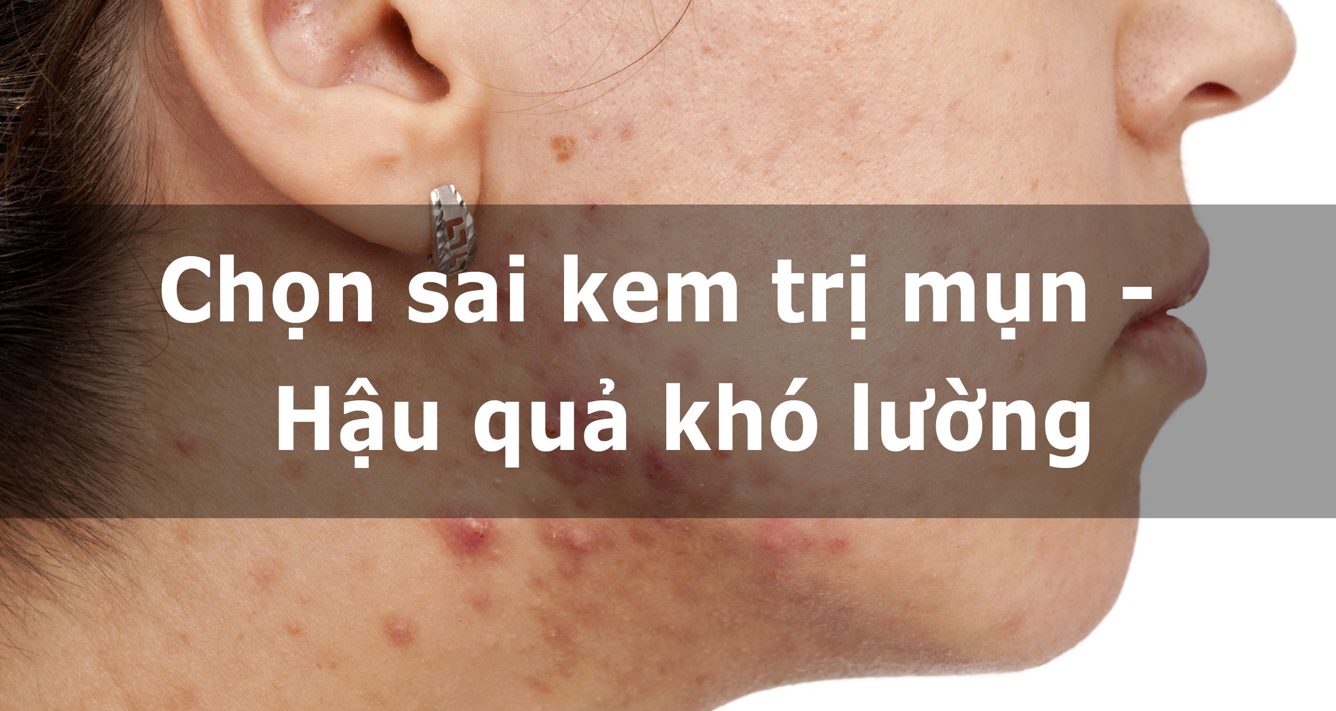 Chọn sai kem trị mụn – Hậu quả khó lường