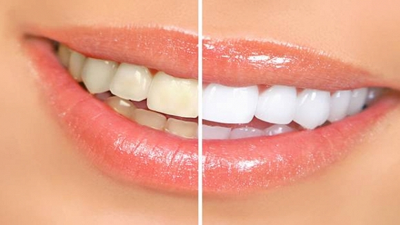 Công thức loại bỏ cao răng tại nhà đầy bất ngờ