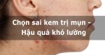 Chọn sai kem trị mụn – Hậu quả khó lường