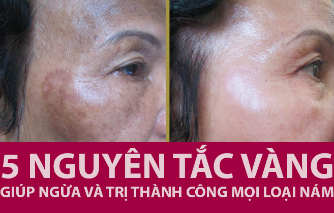 Thuộc ngay 5 nguyên tắc bất di bất dịch để da không bị nám!