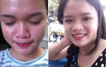 Mẹo trị mụn, thu lỗ chân lông to thành công bất ngờ chỉ trong 2 tháng