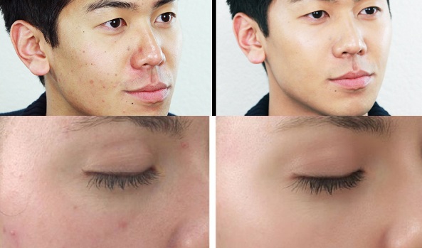 Thuốc trị mụn tận gốc cho cả nam lẫn nữ