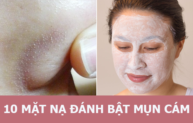 10 mặt nạ tự nhiên giúp thổi bay mụn cám không thể bỏ qua