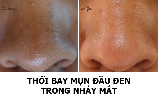 Mẹo thổi bay mụn đầu đen cứng đầu trong nháy mắt