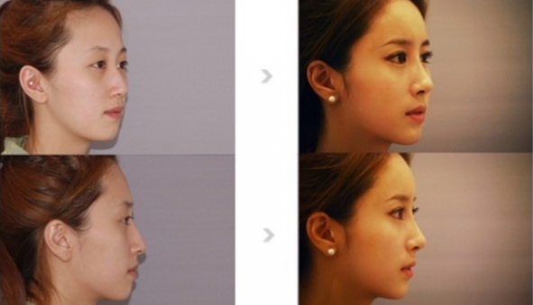 Hướng dẫn cách nâng mũi không cần phẫu thuật thẩm mỹ