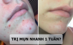 Phát hiện bất ngờ giúp trị mụn trong nháy mắt