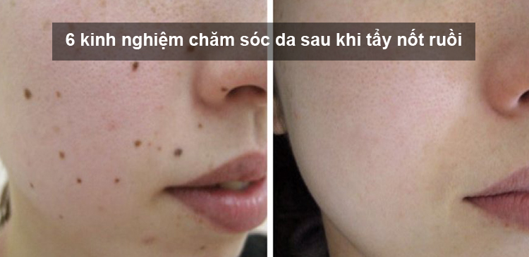 6 kinh nghiệm chăm sóc da sau khi tẩy nốt ruồi