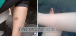 8 cách tự làm mờ sẹo tại nhà