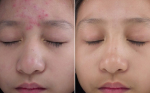 Mặt nạ mật ong - muối - liệu pháp thần kỳ cho da mụn
