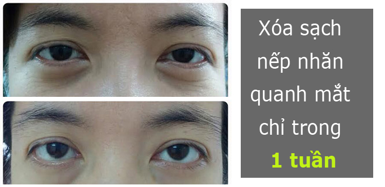 Xóa sạch nếp nhăn quanh mắt chỉ trong 1 tuần