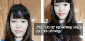 Tôi đã "chia tay" mụn chỉ trong 10 ngày, bạn muốn thử không?