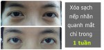 Xóa sạch nếp nhăn quanh mắt chỉ trong 1 tuần
