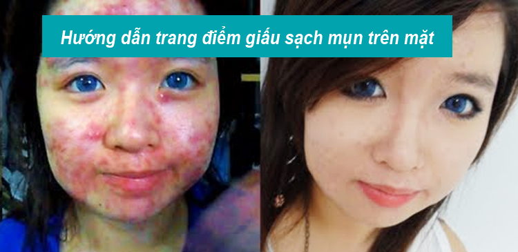 3 phút trang điểm giấu sạch mụn trên mặt