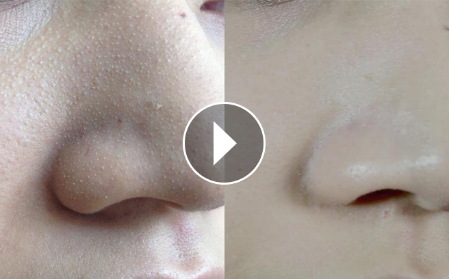 Mẹo trị mụn đầu đen, mụn cám, se lỗ chân lông tại nhà cực hiệu quả