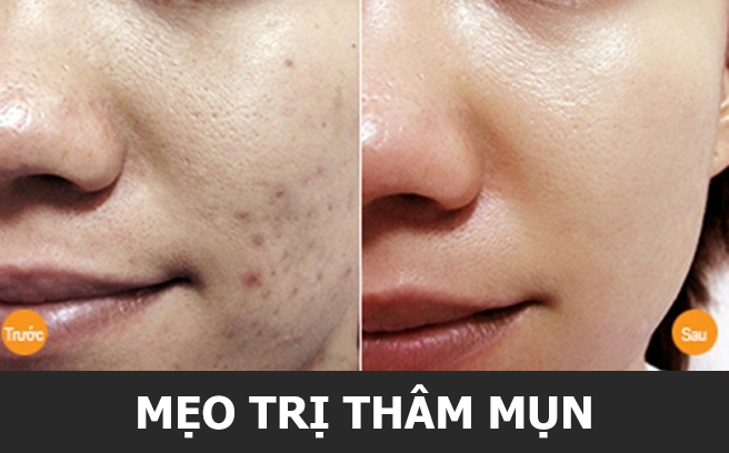 4 mẹo giúp trị thâm mụn cực hiệu quả chỉ trong 7 ngày!