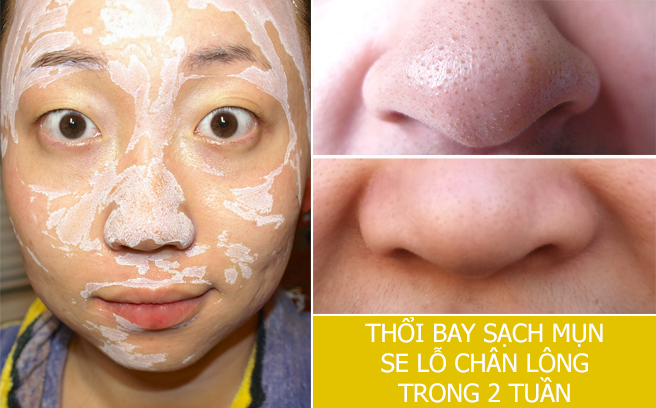 Kinh nghiệm thổi bay mụn, se lỗ chân lông chỉ trong 2 tuần!