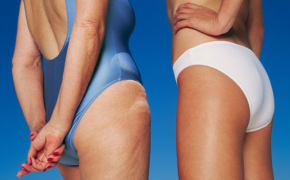 5 mẹo cực hay giúp cải thiện tình trạng da sần vỏ cam