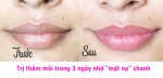 Trị thâm môi trong 3 ngày nhờ "mặt nạ" chanh