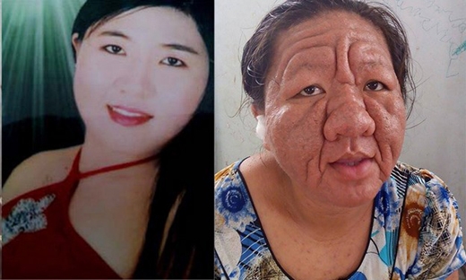 Tác hại kinh khủng của việc tự ý mua thuốc bôi da