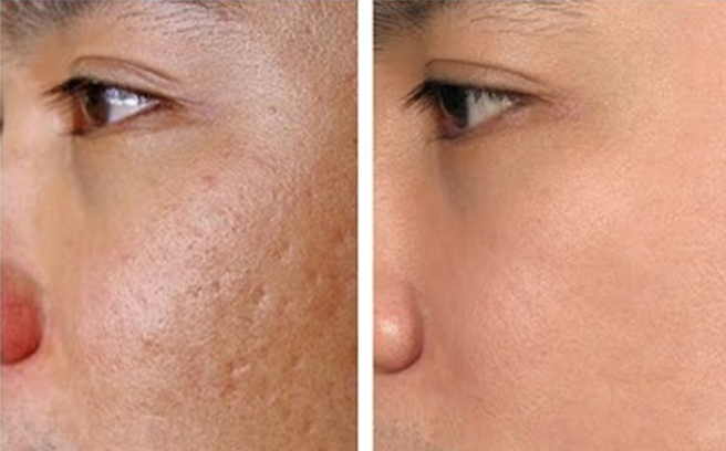 Tuyệt chiêu trị sẹo rổ cực hay không thể bỏ qua