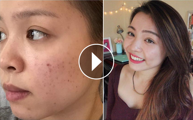 Mẹo giúp đánh bật thâm mụn cho da sáng trắng mịn màng nhanh chóng