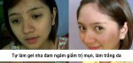 Tự làm gel nha đam ngâm giấm trị mụn, làm trắng da