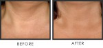 Xóa bỏ lão hóa da cổ trong 10 ngày