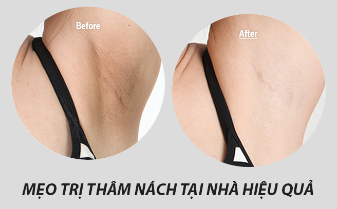 Mẹo đơn giản giúp da vùng dưới cánh tay sáng mịn