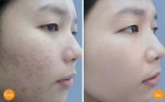 Trị thâm mụn thành công chỉ trong 2 tuần nhờ mẹo hay của mẹ