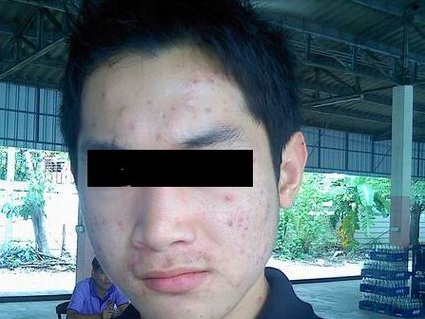 Trị mụn thành công để... lấy vợ