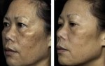 Chia sẻ trải nghiệm điều trị nám thành công của khách hàng