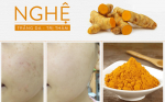 Trị thâm mụn nhanh chóng với tinh bột nghệ ngâm rượu