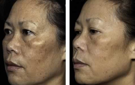 Chia sẻ trải nghiệm điều trị nám thành công của khách hàng
