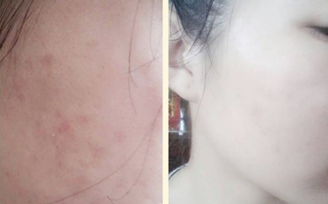 Kinh nghiệm trị sạch mụn chỉ tròn tuần không thể bỏ qua
