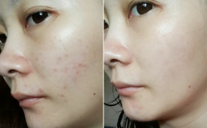 Khỏi mụn 100‰ với chi phé rẻ bèo
