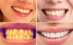 3 mẹo giúp răng trắng sáng hiệu quả hơn cả nha sĩ