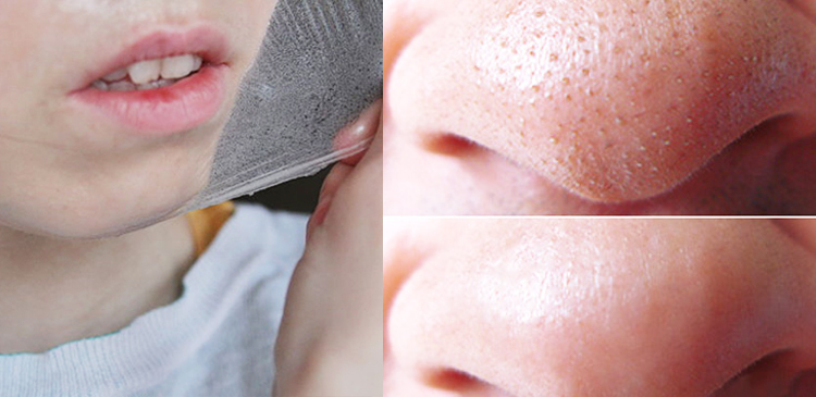 Bị mụn dày đặc nơi cánh mũi, hãy lột bằng sữa tươi