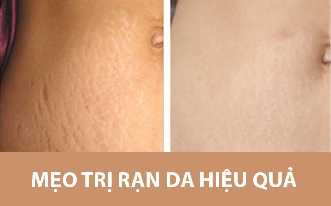 Mẹo hay giúp loại bỏ vết rạn da xấu xí