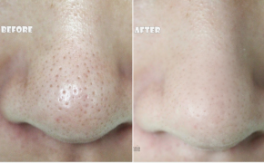 3 tuyệt chiêu se lỗ chân lông cực hay không thể bỏ qua