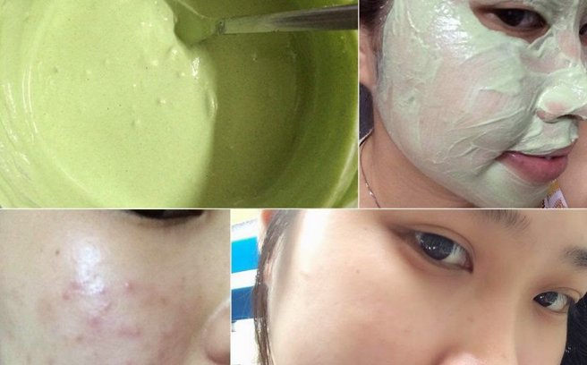 Bí quyết dưỡng trắng da trị mụn với bột trà xanh nguyên chất